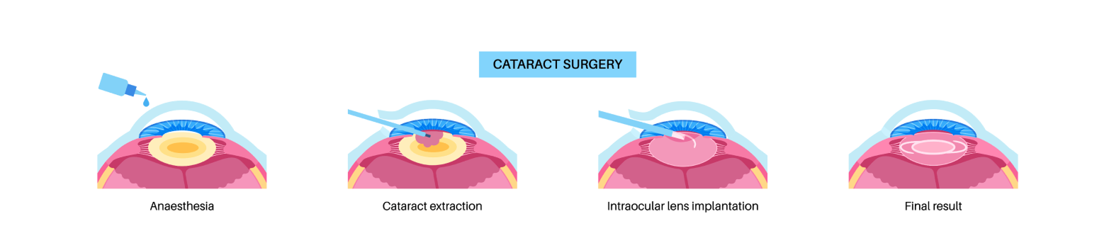 Types d'implants intraoculaires