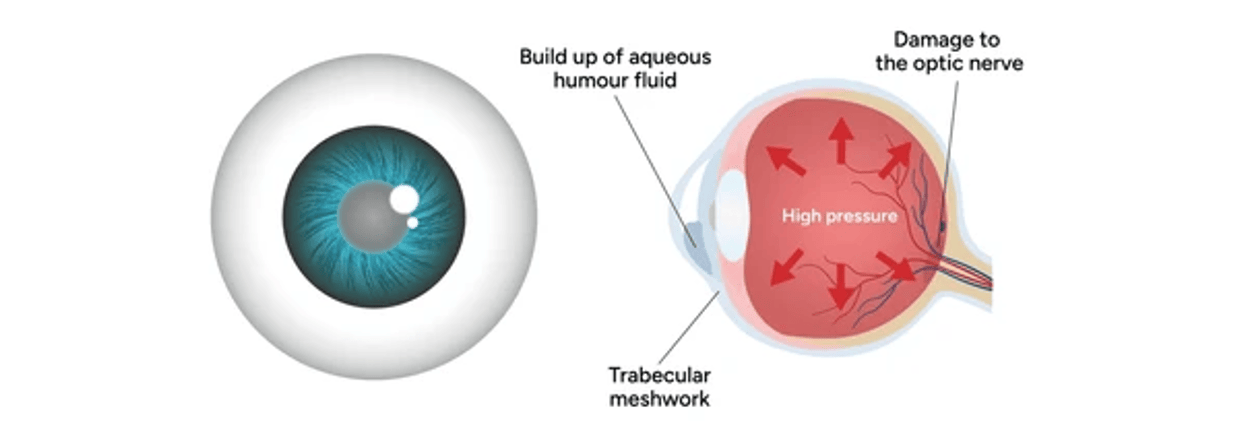 Glaucome - nerf optique