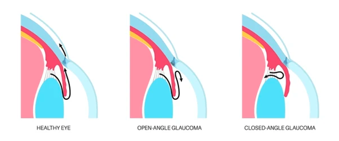 Glaucome à angle fermé