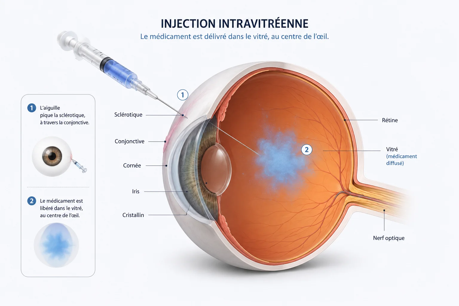 Injections intra-vitréennes (IVT)