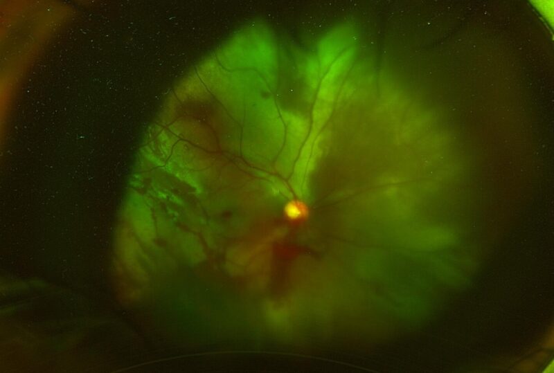 Rétinopathie traumatique