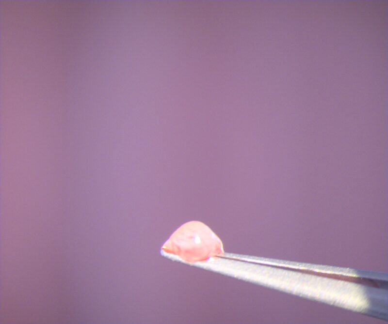 Ablation d'un kyste d'inclusion conjonctival photographié.