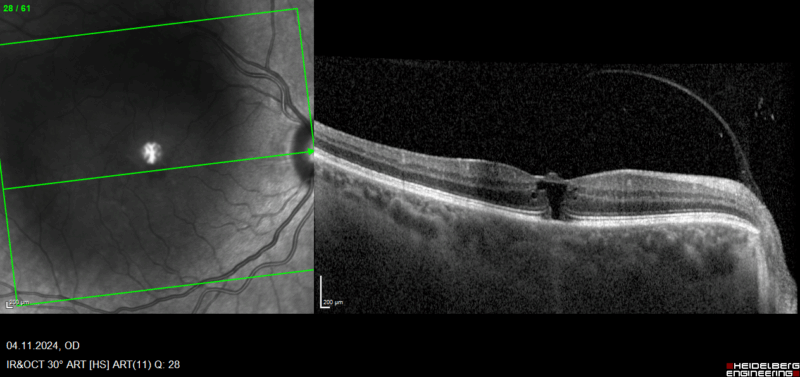 Image d'une coupe de tomographie en cohérence optique (OCT) d'un patient présentant une situation de traction vitréomaculaire tout juste relâchée. La rétine présente un trou noir (hyporéflectif) en son centre avec un toit préservé et une petit protubérance qui indique que le gel s'est détaché récemment en tirant sur la rétine. La ligne au-dessus montre l'enveloppe du gel que l'on nomme "hyaloïde postérieure".