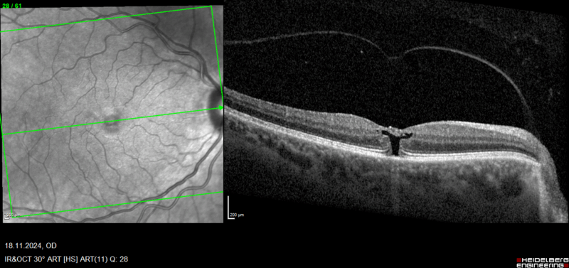 Image d'une coupe de tomographie à cohérence optique (OCT) montrant une diminution de la béance avec préservation du toit. On note la ligne hyperréflective dans la cavité vitréenne signant une hyaloïde complètement détachée.