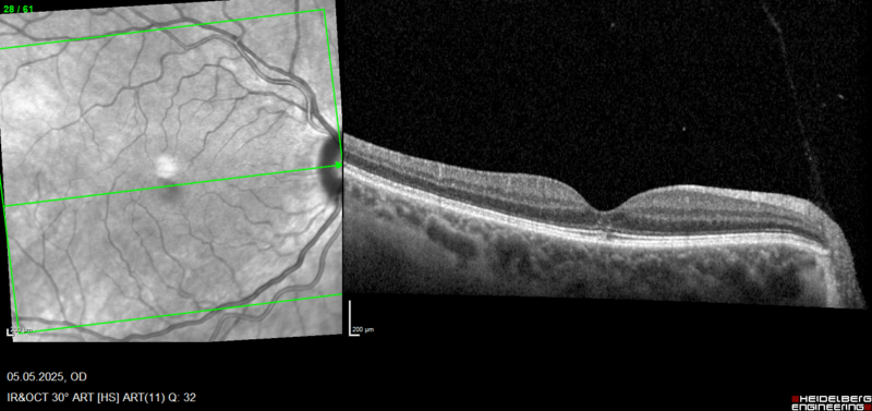 A 6 mois, l'acuité visuel est à 100%. On note un aspect discrètement moucheté et altéré des couches externes. Le gel s'est encore plus rétracté avec la limite (hyaloïde corticale) qui n'est plus visible. Aucun traitement n'a dû être entrepris. Seule la nature a fait son travail.